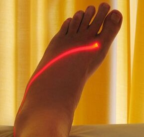tratamentul cu laser al varicelor de pe picioare