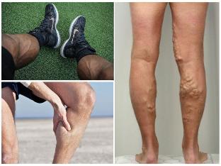 propolisul tratează venele varicoase perna de picior ortopedică cu varicoză