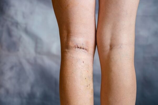 cusătură pe picior după intervenția chirurgicală pentru varice