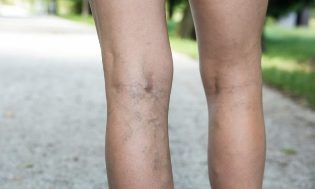tratamentul lui phlebitis varicoza varicoza inflamaie pe unguent picior
