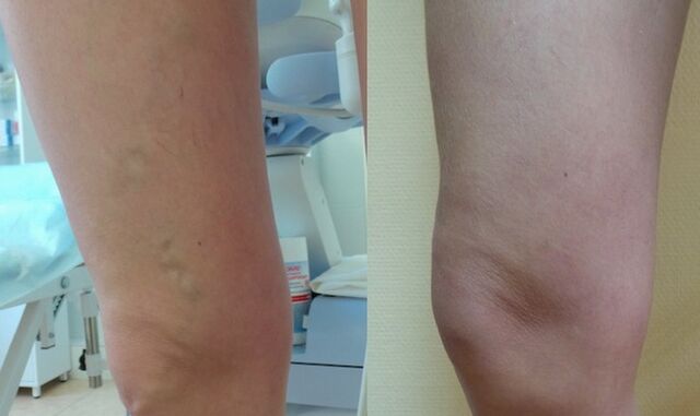 picior înainte și după tratamentul varicelor reticulare
