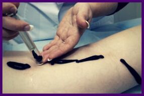 Procedura de tratare a venelor varicoase cu lipitori (hirudoterapie)