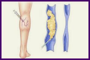 Scleroterapia este o metodă populară de a scăpa de vene varicoase de pe picioare