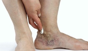 manifestări ale varicelor pe picioare