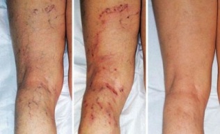 simptome ale varicelor la nivelul picioarelor