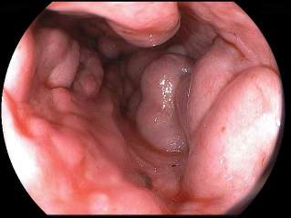varicele esofagiene