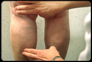 Medicul examinează picioarele cu vene varicoase