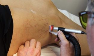 tratamentul varicelor cu laser