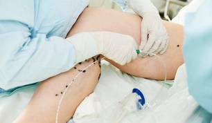 metode de tratare a varicelor pe picioare la femei